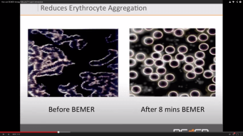 Bemer RBCells Chitvan before-aft